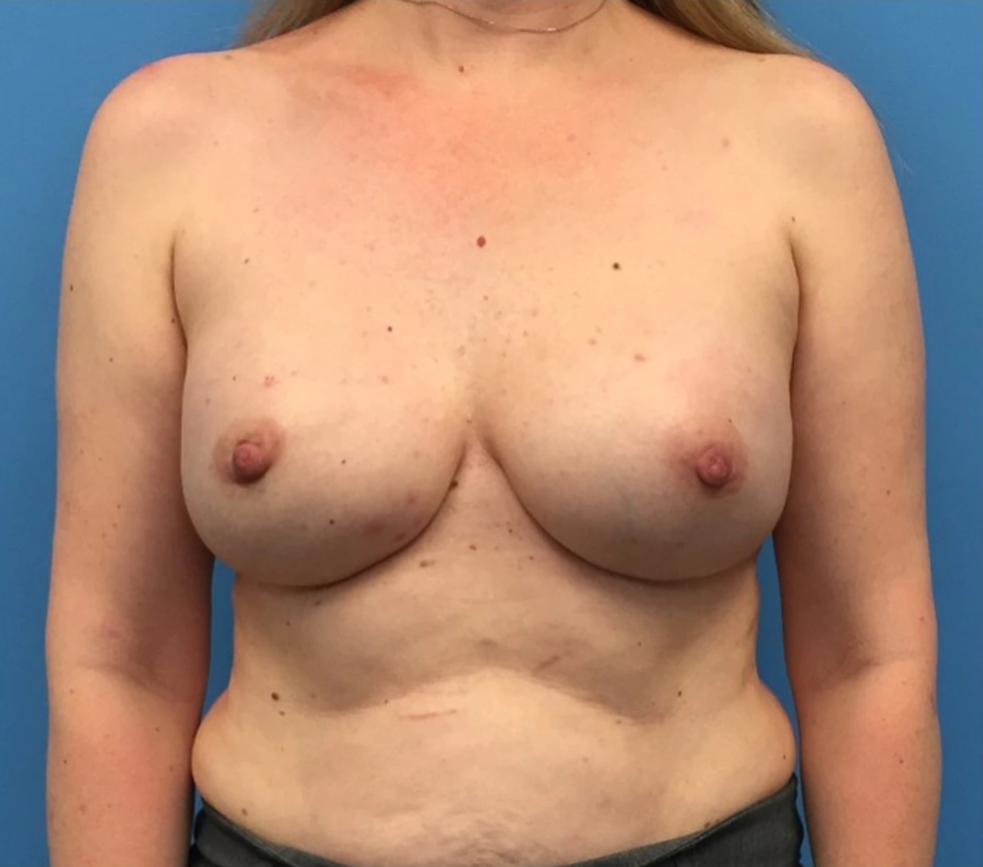 After breast reconstruction, front view