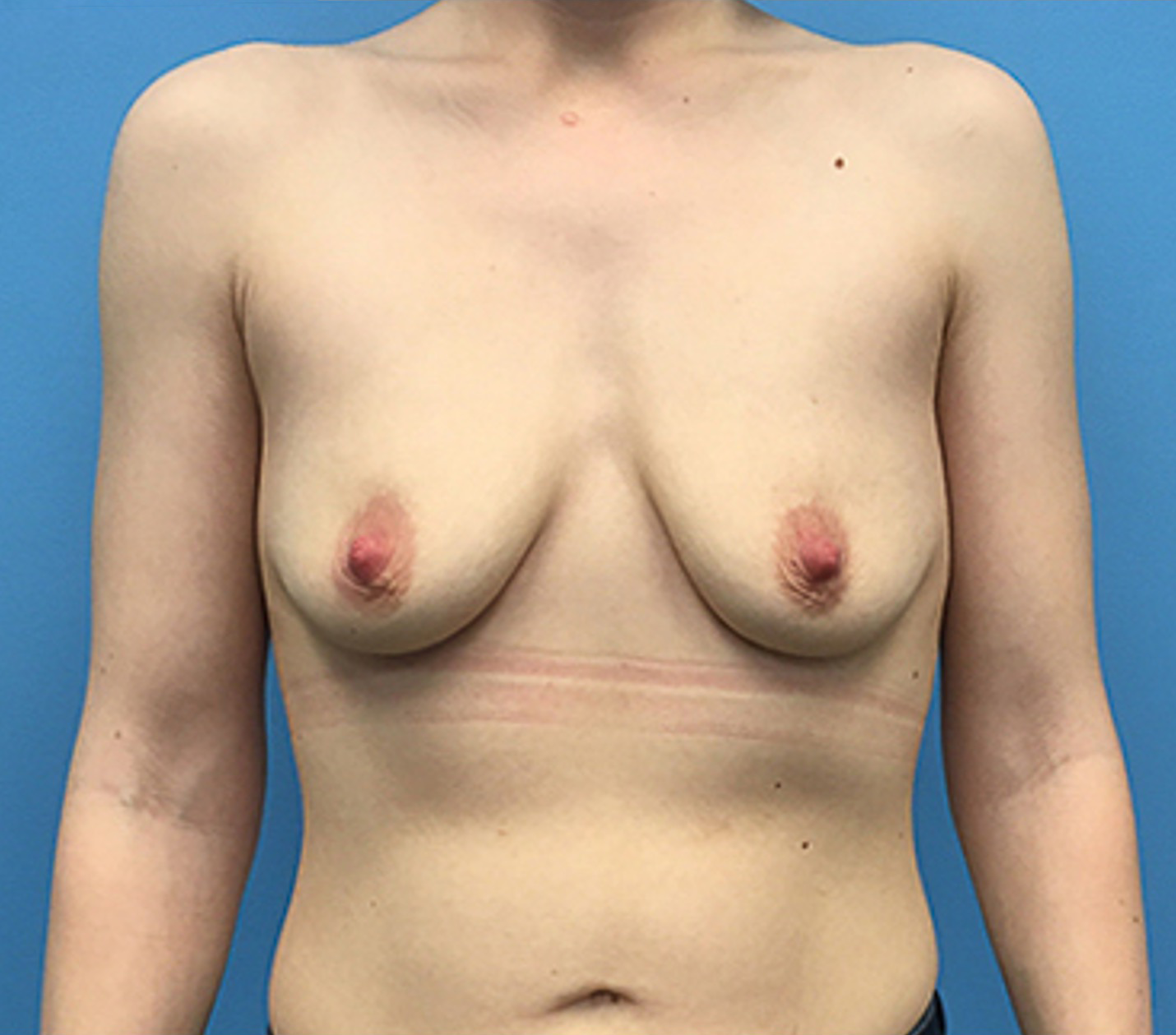 Before breast augmentation, front view