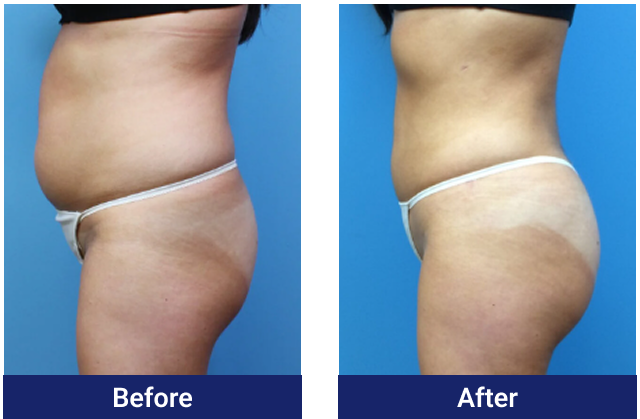 Brazilian butt lift before and after, side view