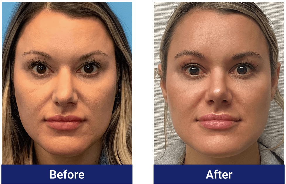 Rhinoplasty before and after, front view