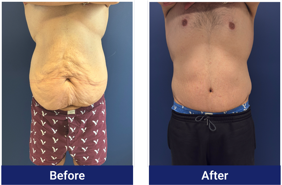 Body lift before and after, front view