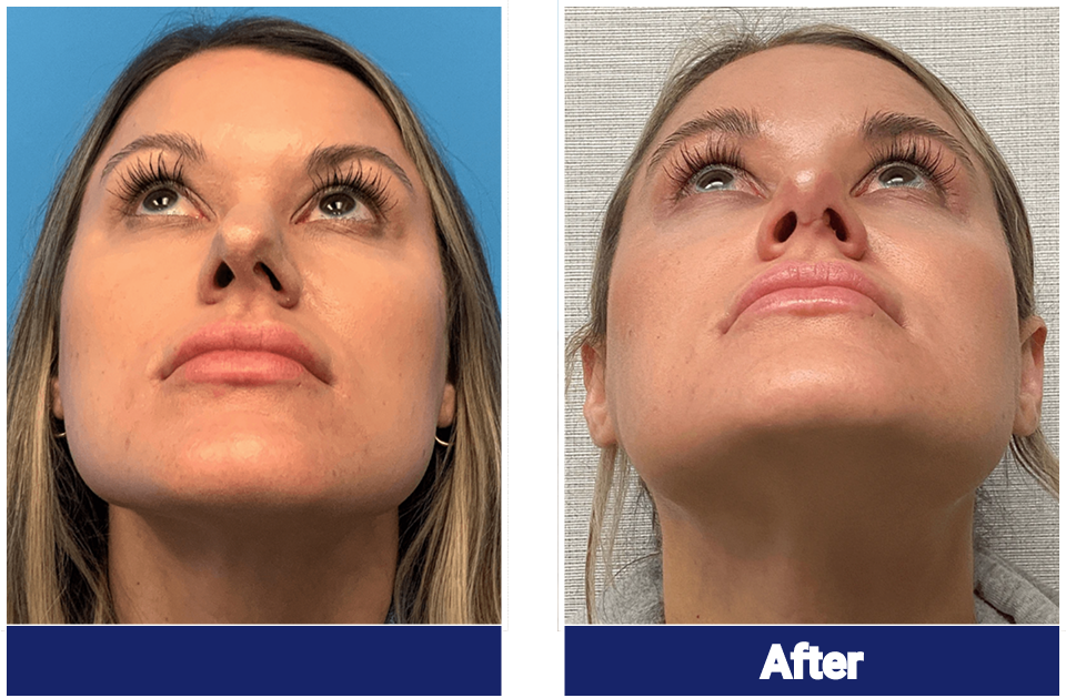 Rhinoplasty before and after, base view