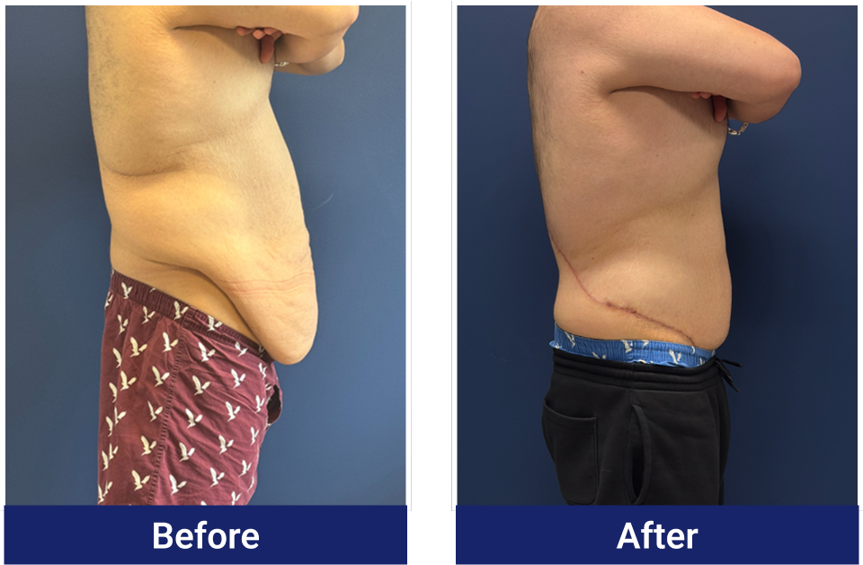 Body lift before and after, side view