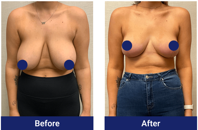 Breast reduction before and after, front view