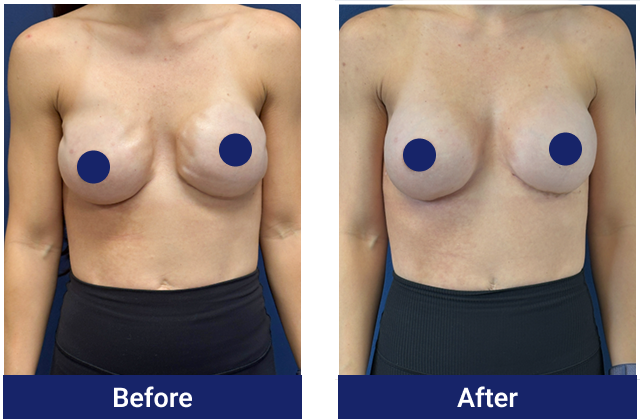 Breast reconstruction before and after, front view