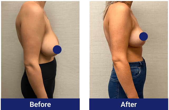 Breast reduction before and after, side view