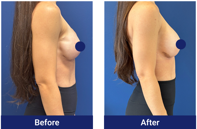 Breast reconstruction before and after, side view
