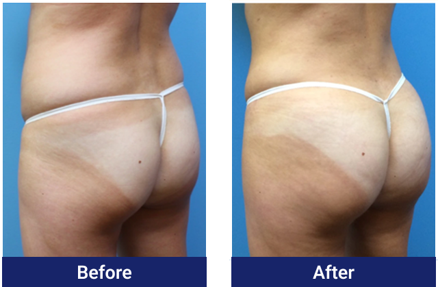Brazilian butt lift before and after, back view