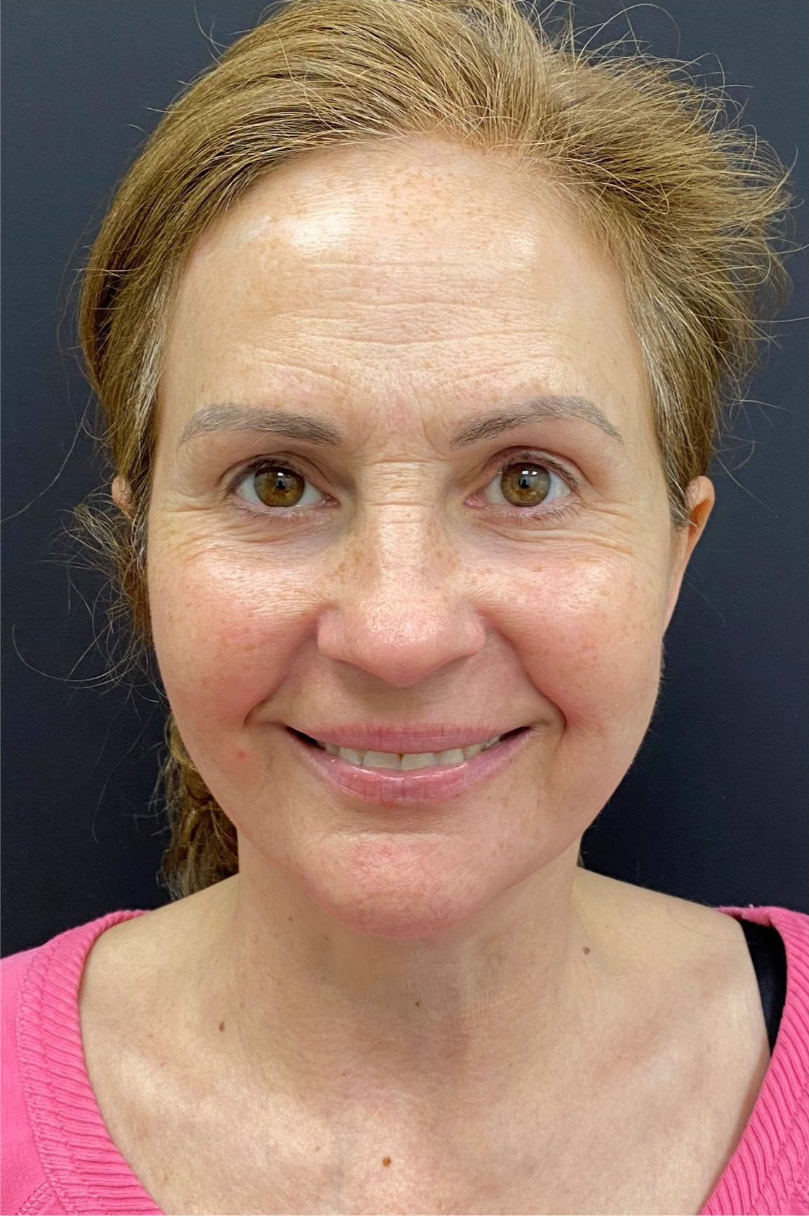 After facelift and neck lift, front view