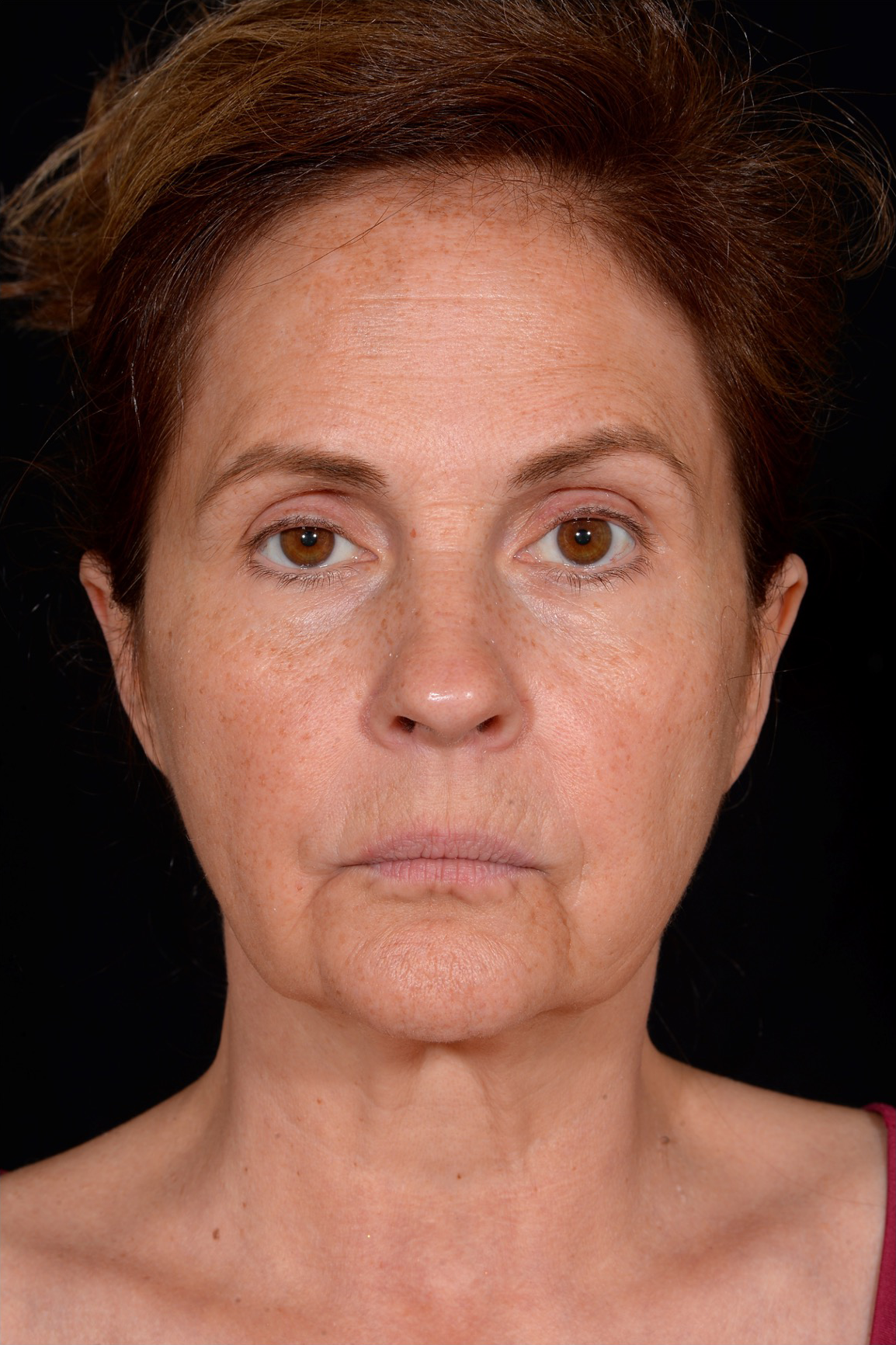 Before facelift and neck lift, front view