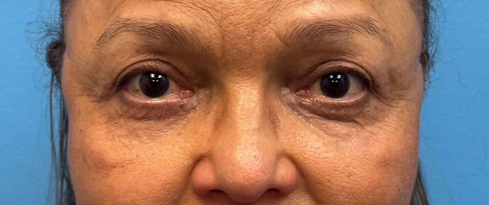After upper eyelid surgery
