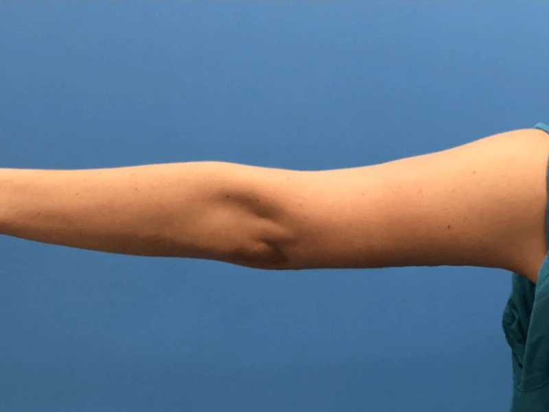 Brachioplasty-Case--276 | After Body 1