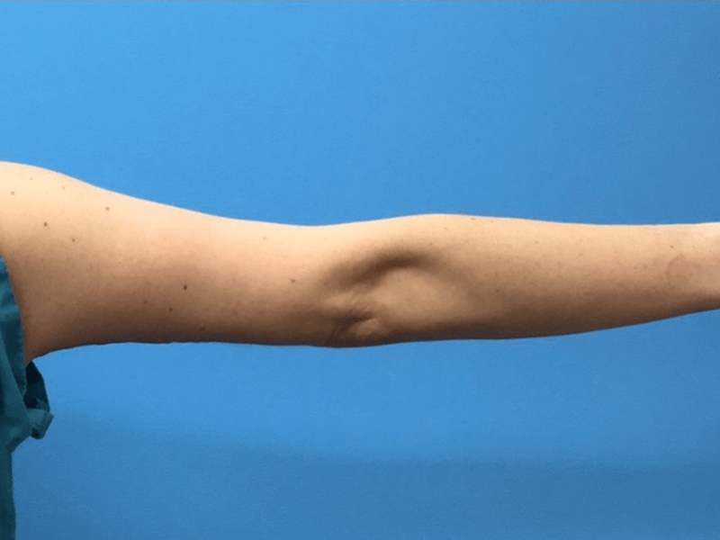 Brachioplasty-Case--276 | After Body 2