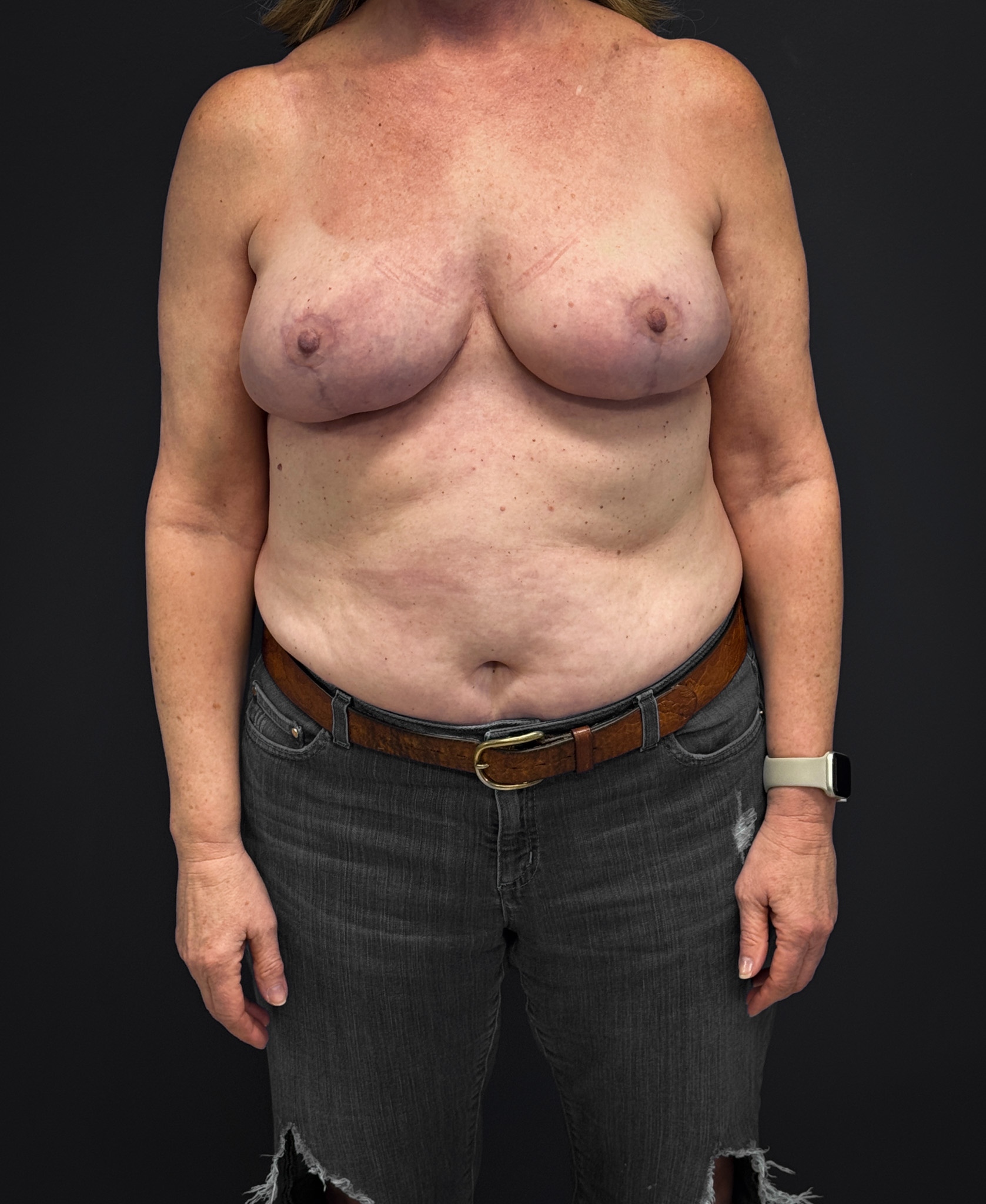 After Mastopexy and Galaflex (front profile)