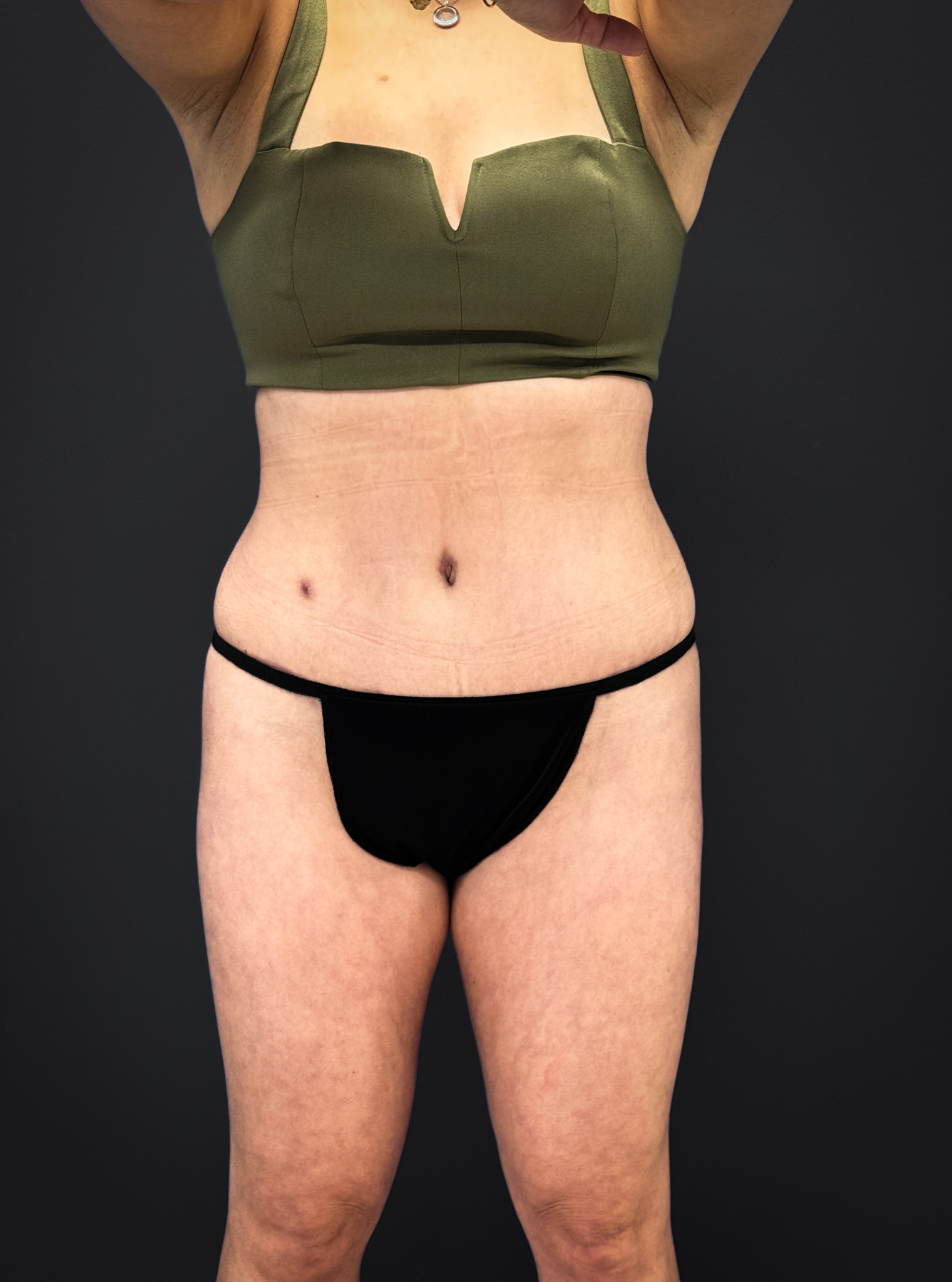 Tummy-Tuck-Case--3757 | After Dr. Samir Rao 1