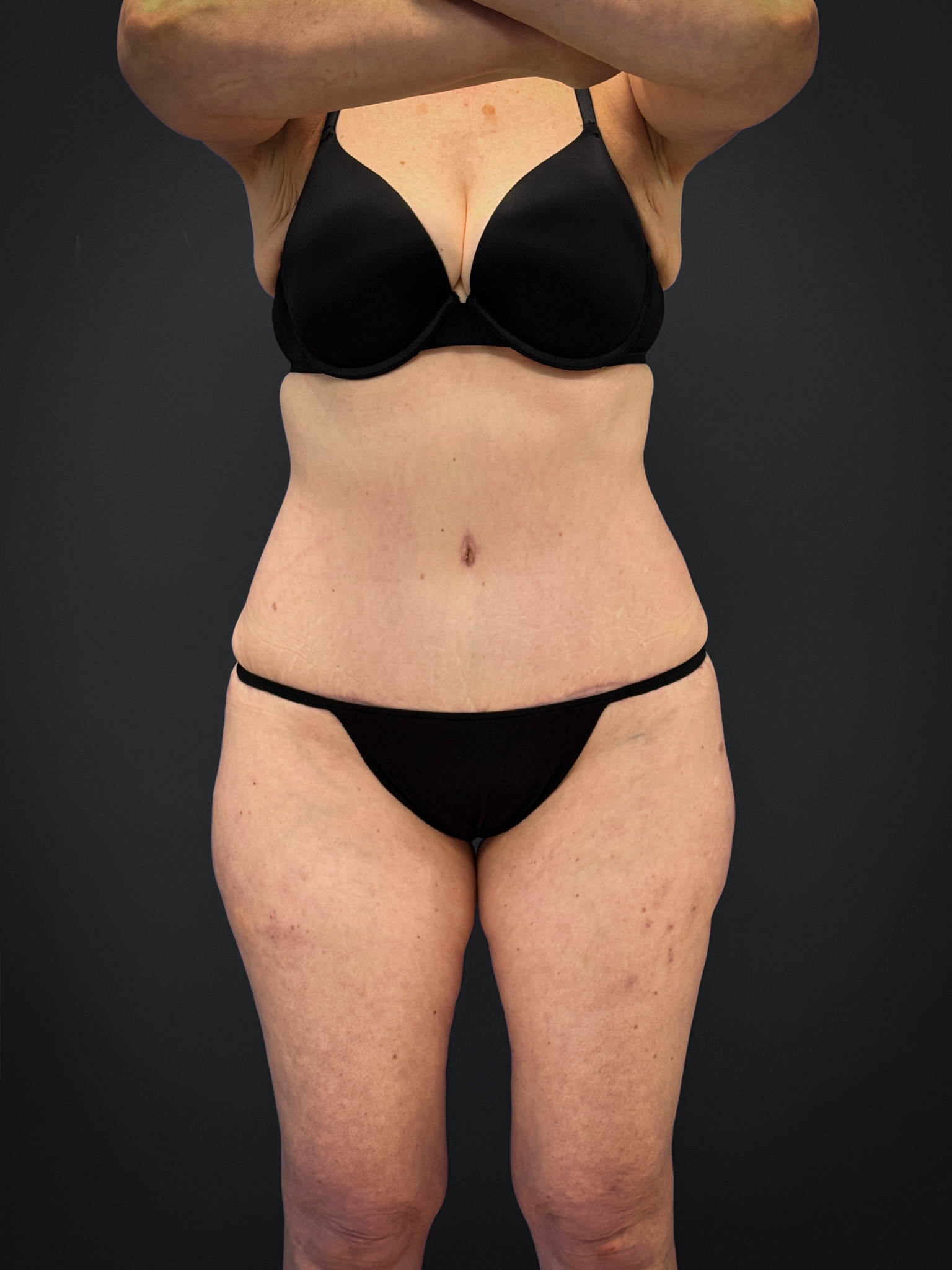 Tummy-Tuck-Case--7170 | After Dr. Samir Rao 1