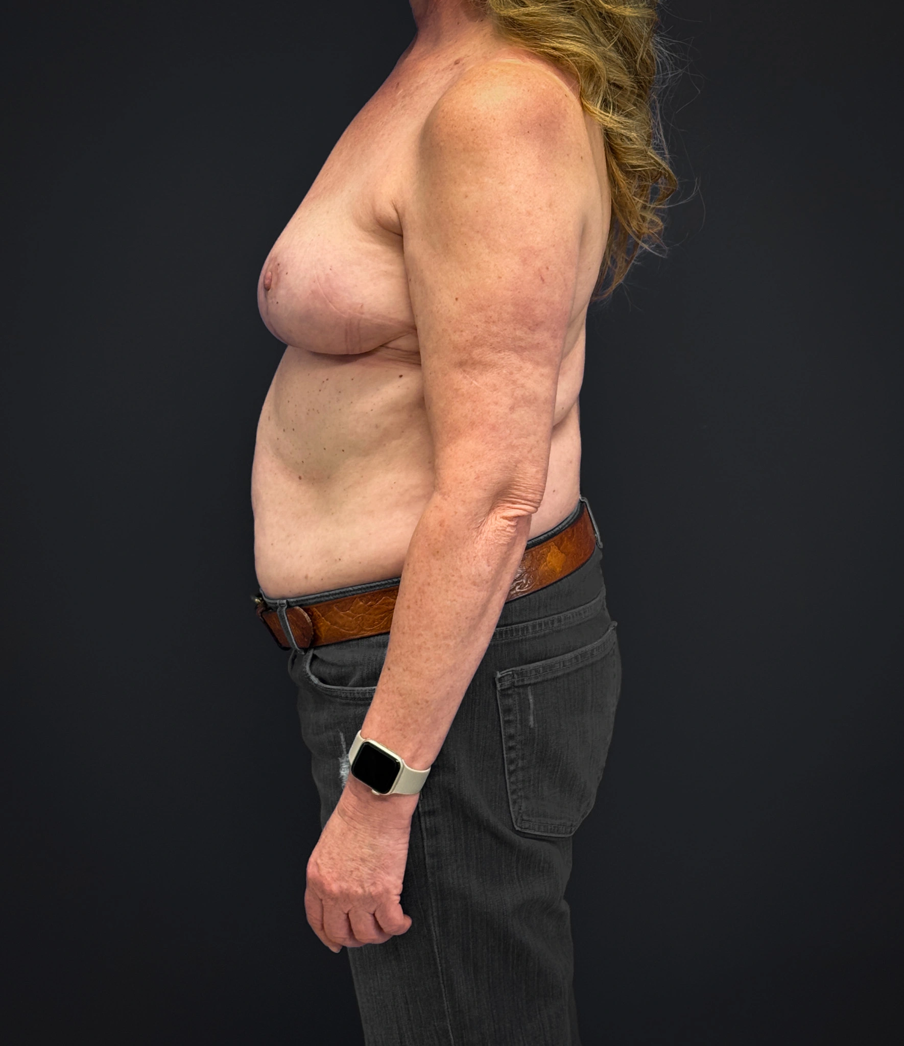 After Mastopexy and Galaflex (Left side profile)