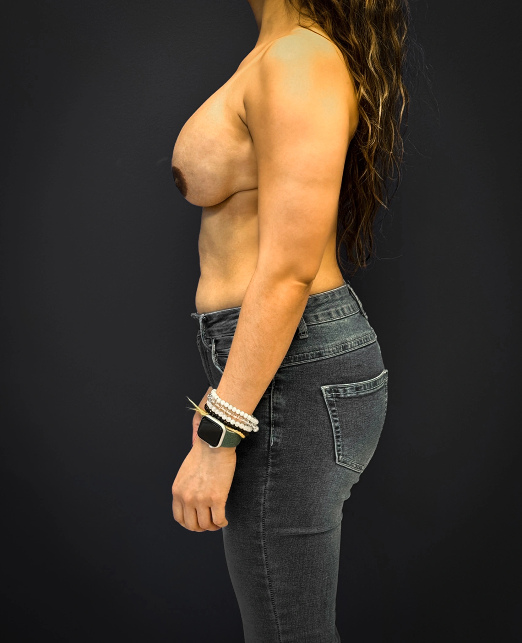 Breast-Reconstruction-Case--7171 | After Breast Reconstruction 2