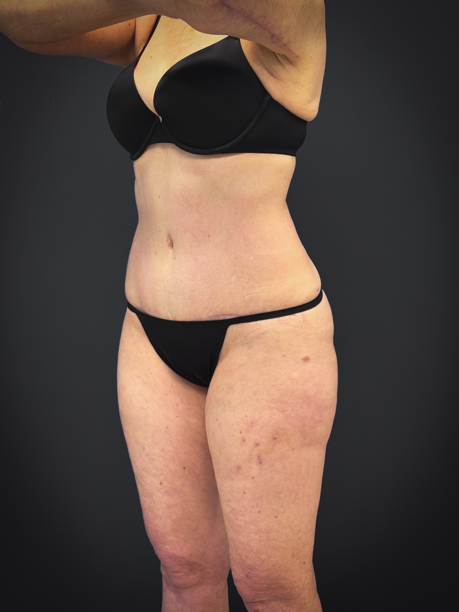 Tummy-Tuck-Case--7170 | After Dr. Samir Rao 2