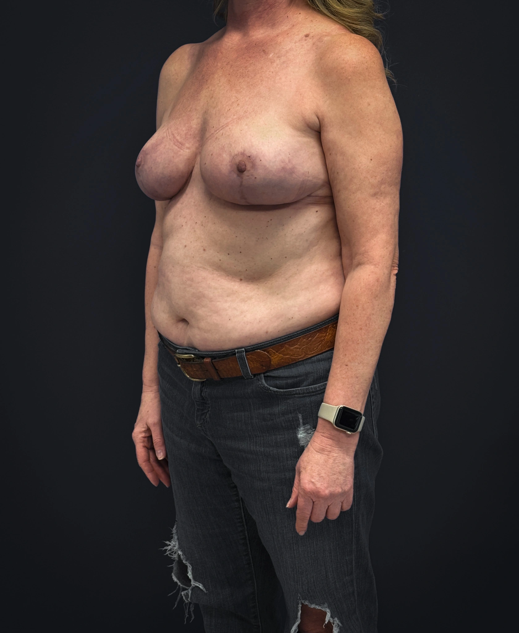 After mastopexy and galaflex (left diagonal profile)