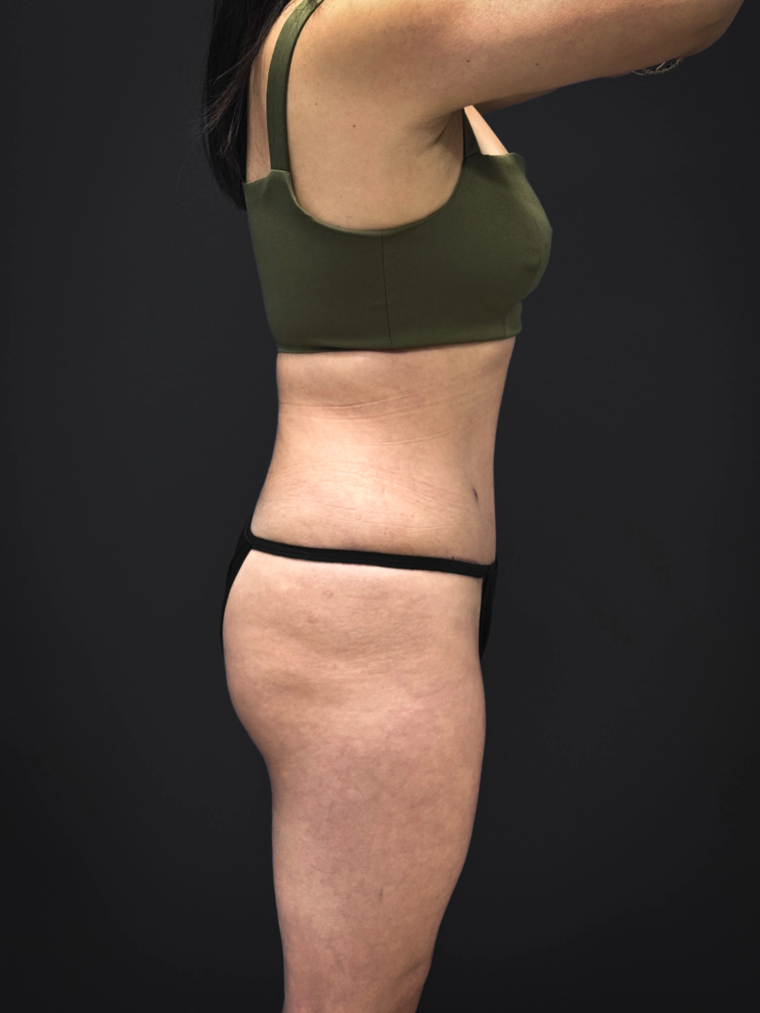 Tummy-Tuck-Case--3757 | After Dr. Samir Rao 2