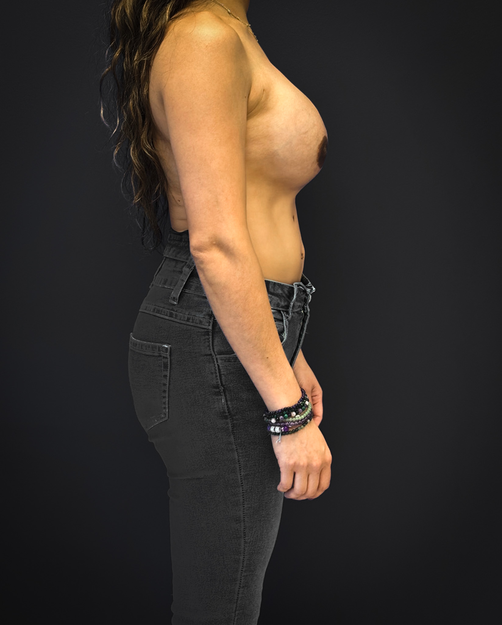 Breast-Reconstruction-Case--7171 | After Breast Reconstruction 3