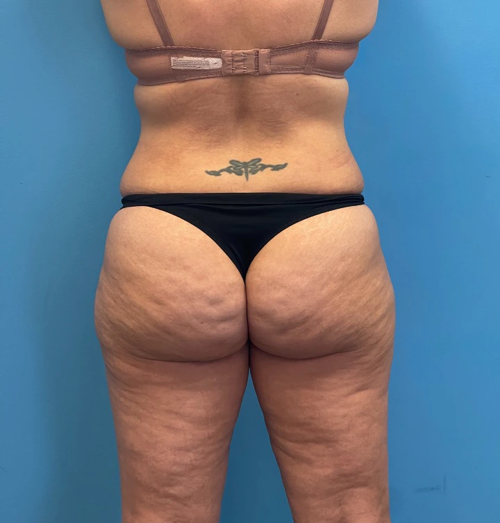 Lipoabdominoplasty-Case--25555 | After Liposuction 4