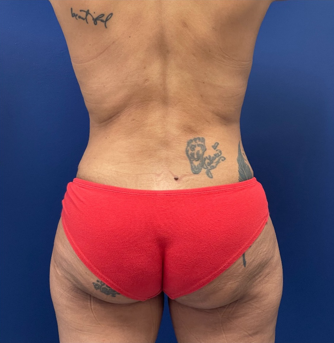 Liposuction-Case--254 | After Liposuction 3
