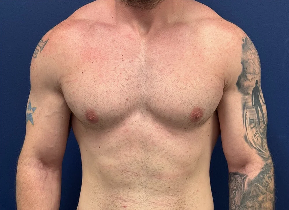 After gynecomastia surgery, front view