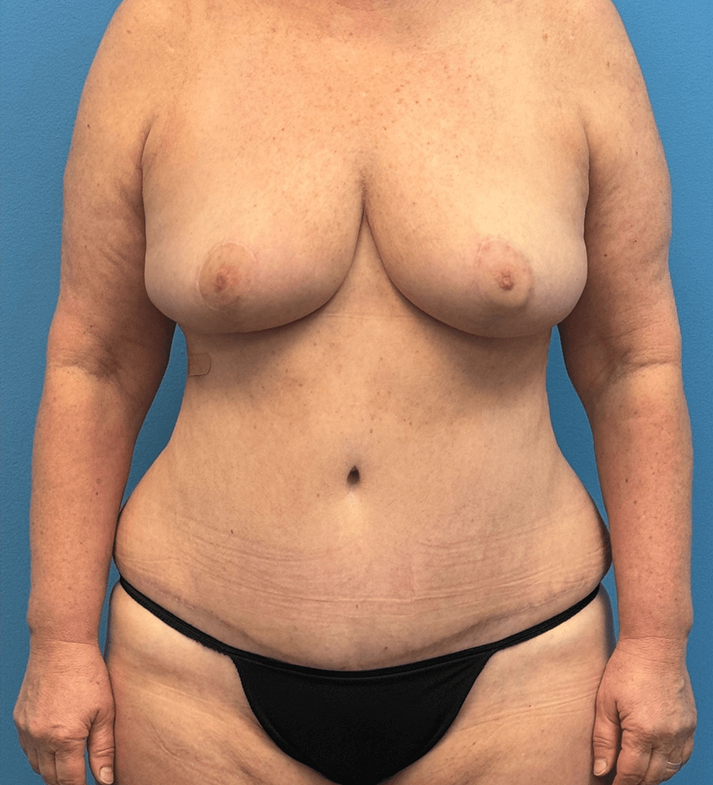 After mommy makeover, front view