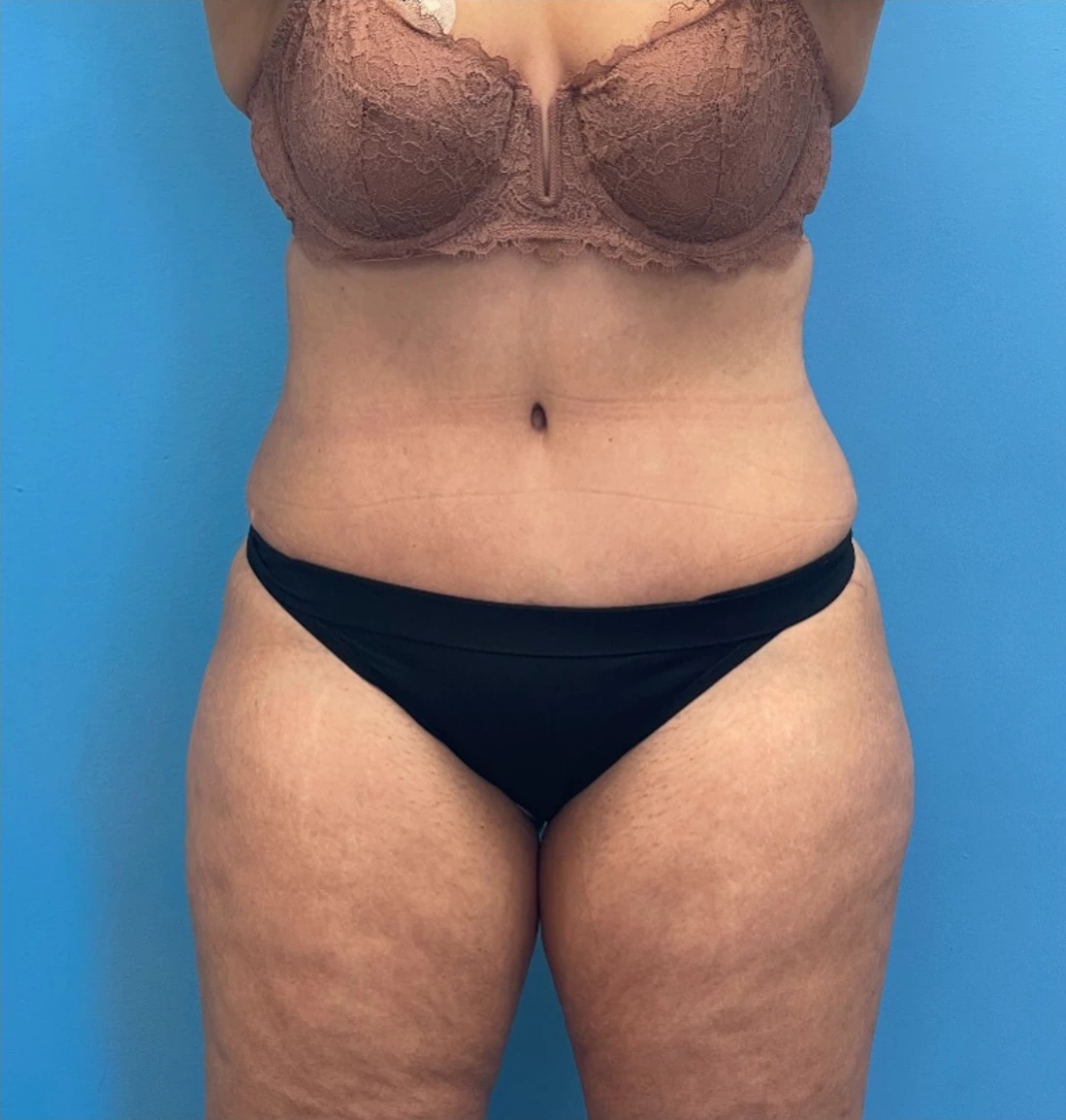 Lipoabdominoplasty-Case--25555 | After Dr. Samir Rao 1
