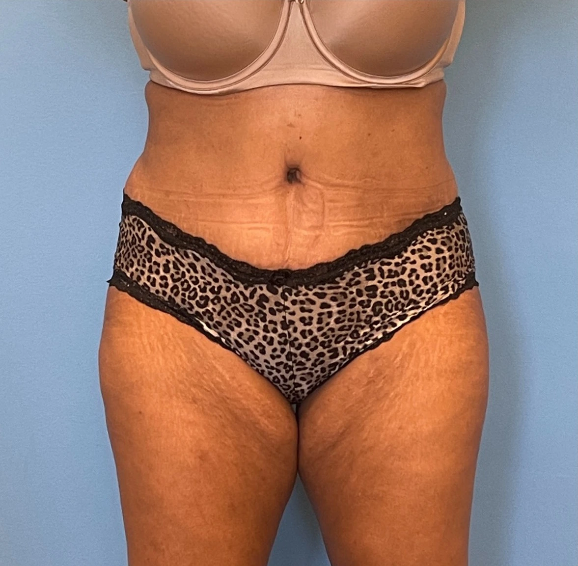 Lipoabdominoplasty-Case--255 | After Dr. Samir Rao 1