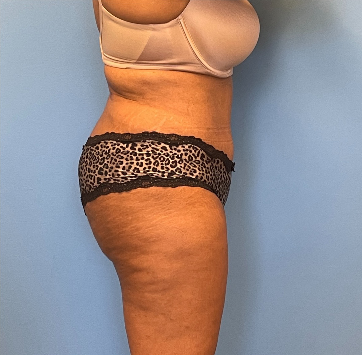 Lipoabdominoplasty-Case--255 | After Dr. Samir Rao 2