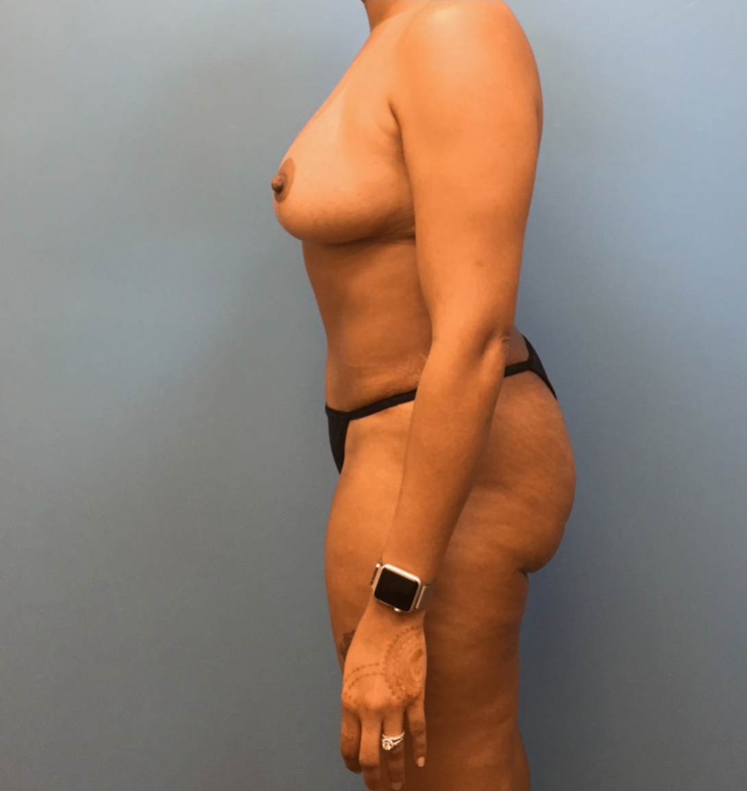 Mommy-Makeover-Case--40 | After Dr. Samir Rao 2
