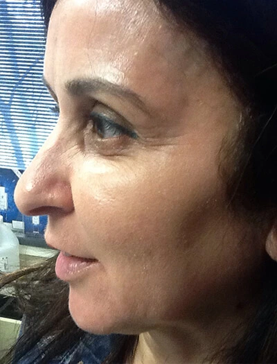 Chemical-Peel-Case--36 | After Skin Care 2