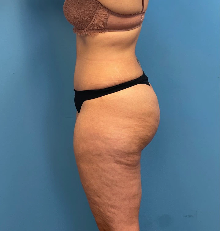 Lipoabdominoplasty-Case--25555 | After Dr. Samir Rao 2
