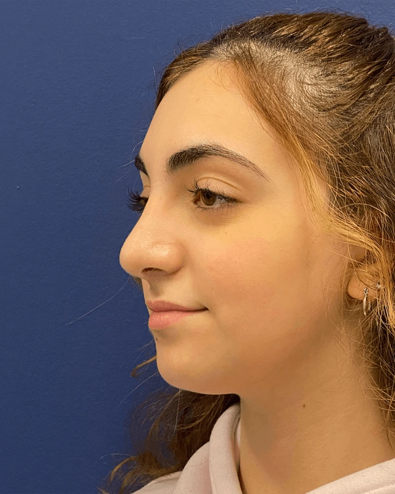 Rhinoplasty-Case--23921 | After Dr. Arjun Kanuri 2