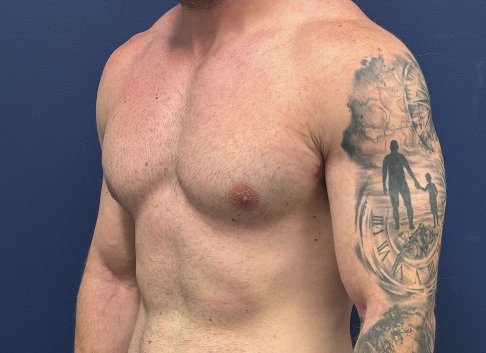 Gynecomastia-Case--28230 | After Dr. Samir Rao 2