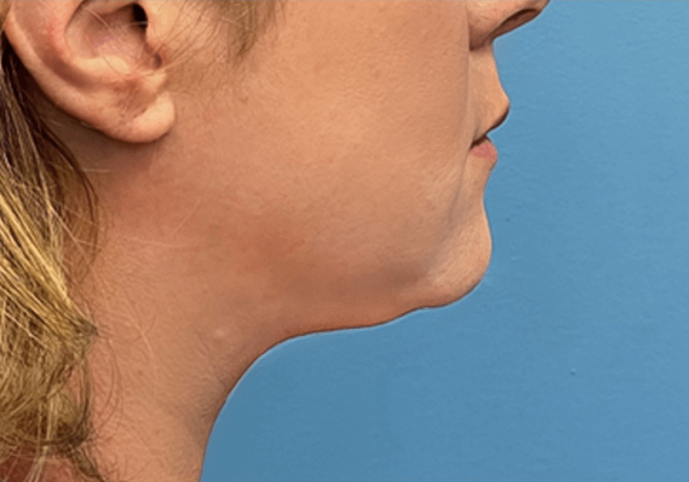 Submental-Liposuction-Case--20811 | After Face 2