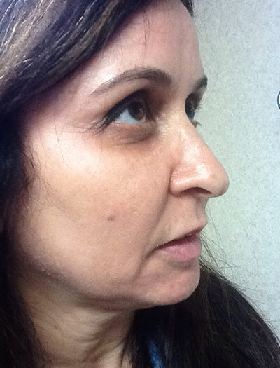 Chemical-Peel-Case--36 | After Skin Care 3