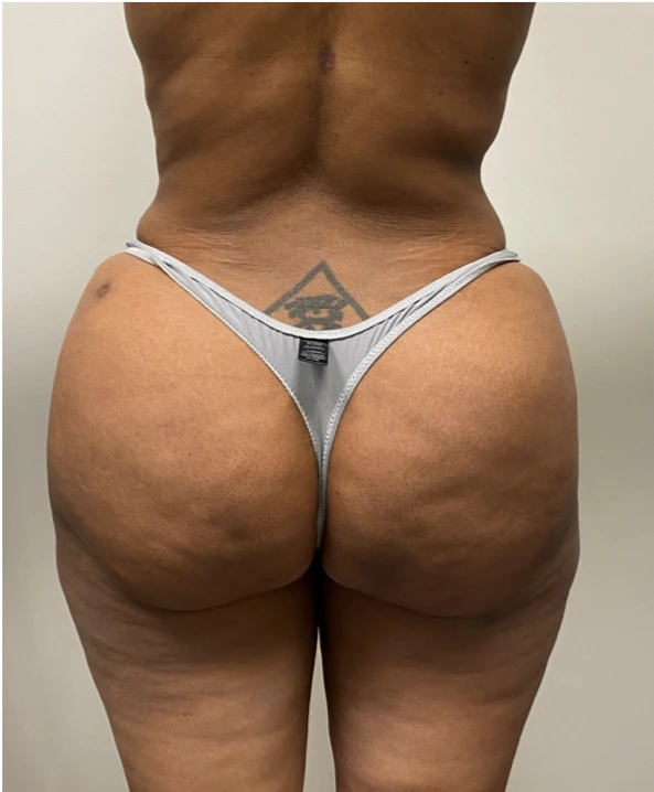 Brazilian-Butt-Lift-Case--7979 | After Dr. Arjun Kanuri 1