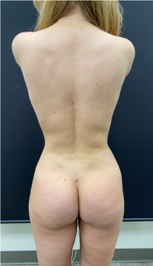 Brazilian-Butt-Lift-Case--5089 | After Brazilian Butt Lift 9