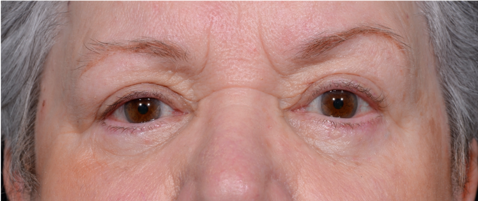 Blepharoplasty-Case--6005 | After Dr. Arjun Kanuri 1