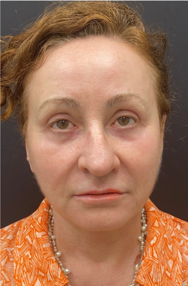 Face-and-Neck-Lift-Case--8423 | After Facelift 1