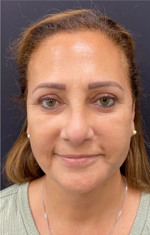 Necklift-Case--4869 | After Neck Lift 1
