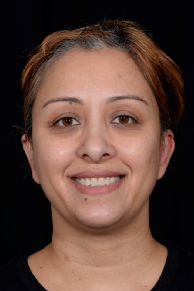 Otoplasty-Case--4655 | After Dr. Arjun Kanuri 1