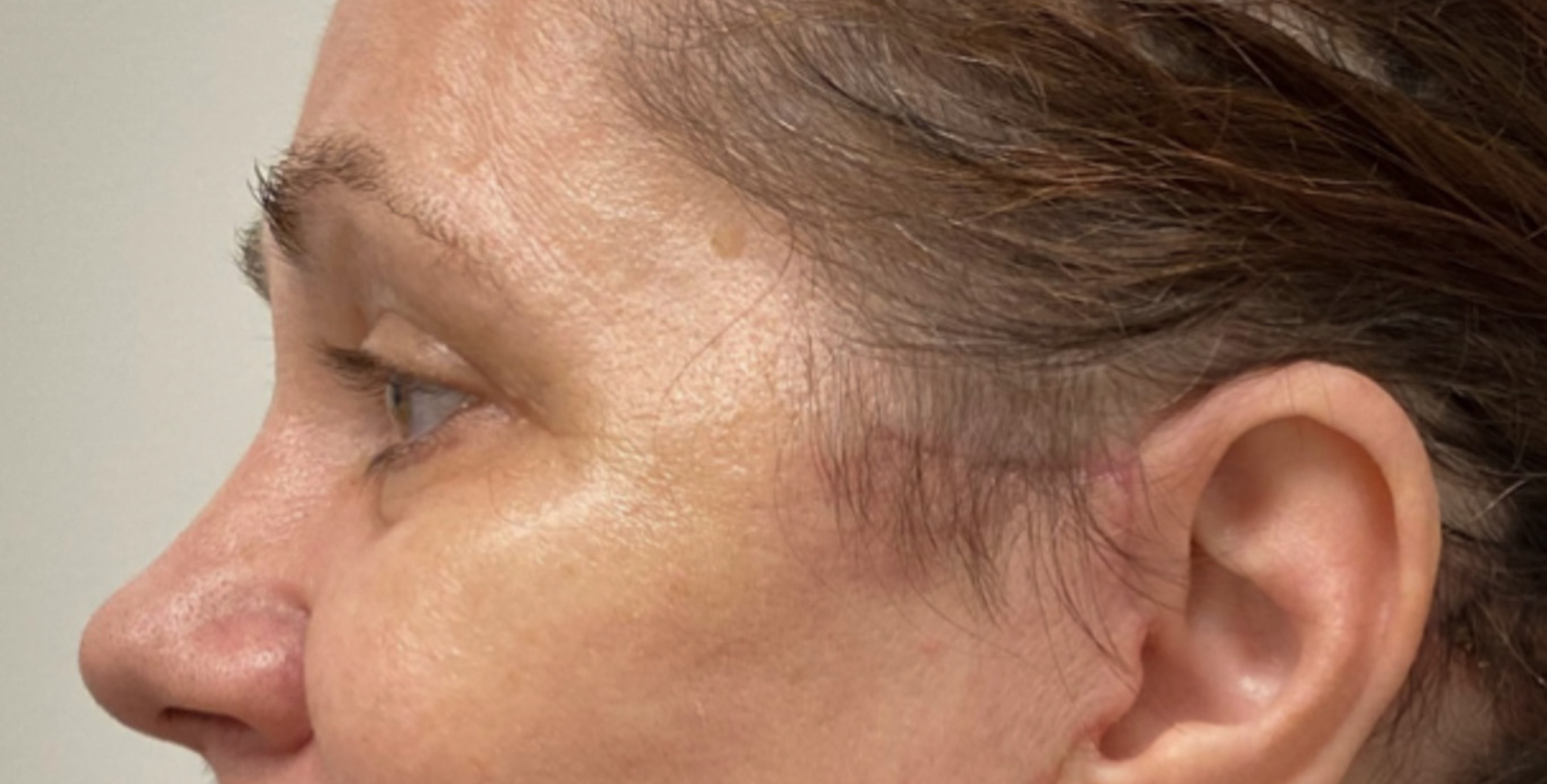 Quad-Blepharoplasty-Case--1851 | After Dr. Arjun Kanuri 2