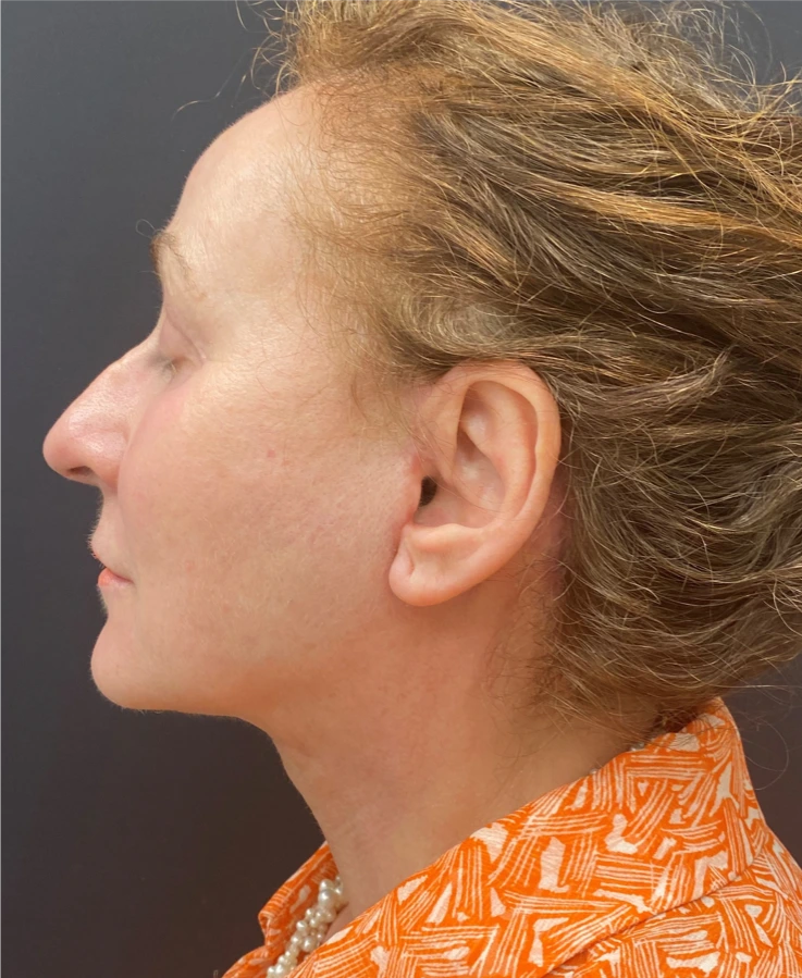 Face-and-Neck-Lift-Case--8423 | After Facelift 2