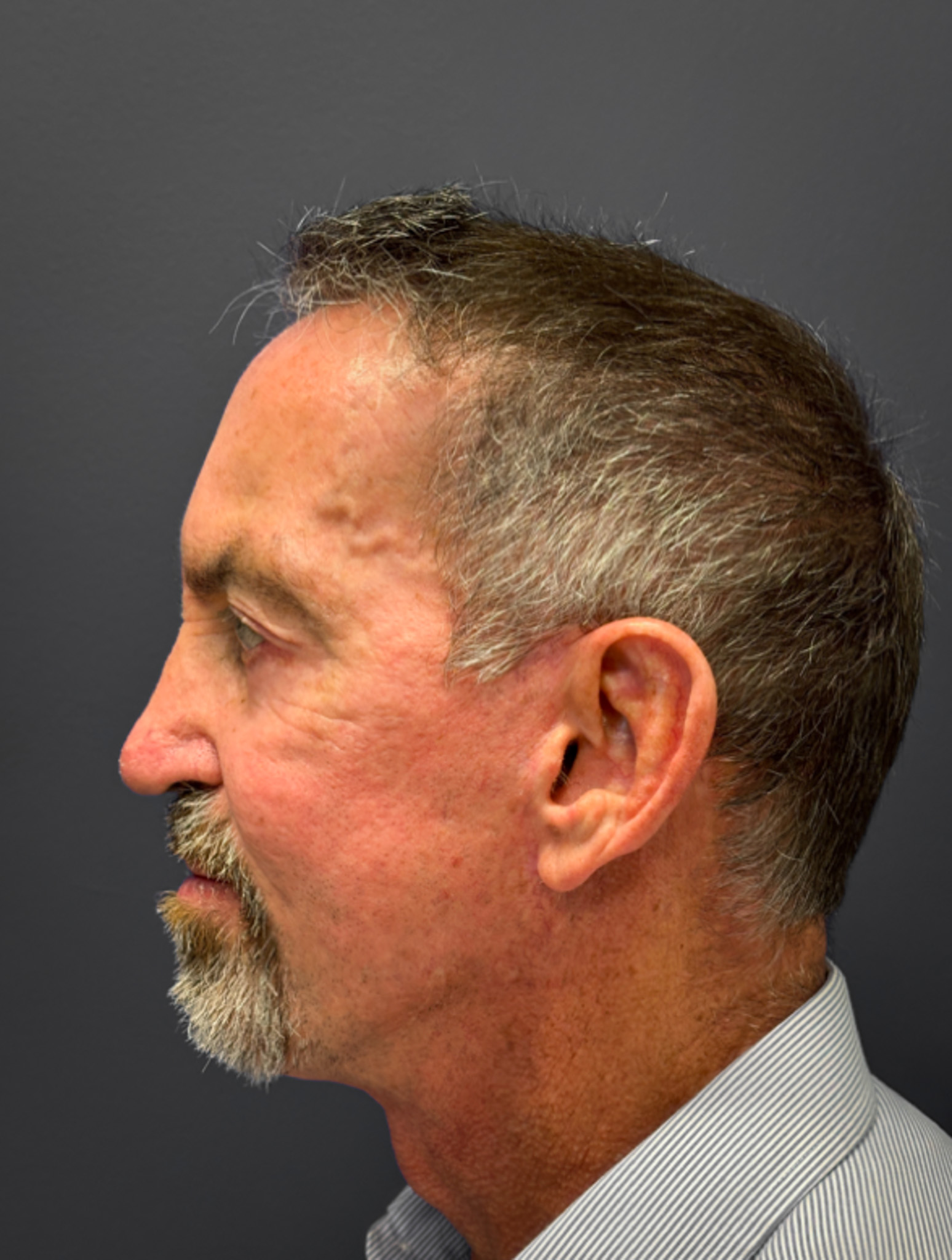 Before Facelift, Rhinoplasty, Blepharoplasty (Side)