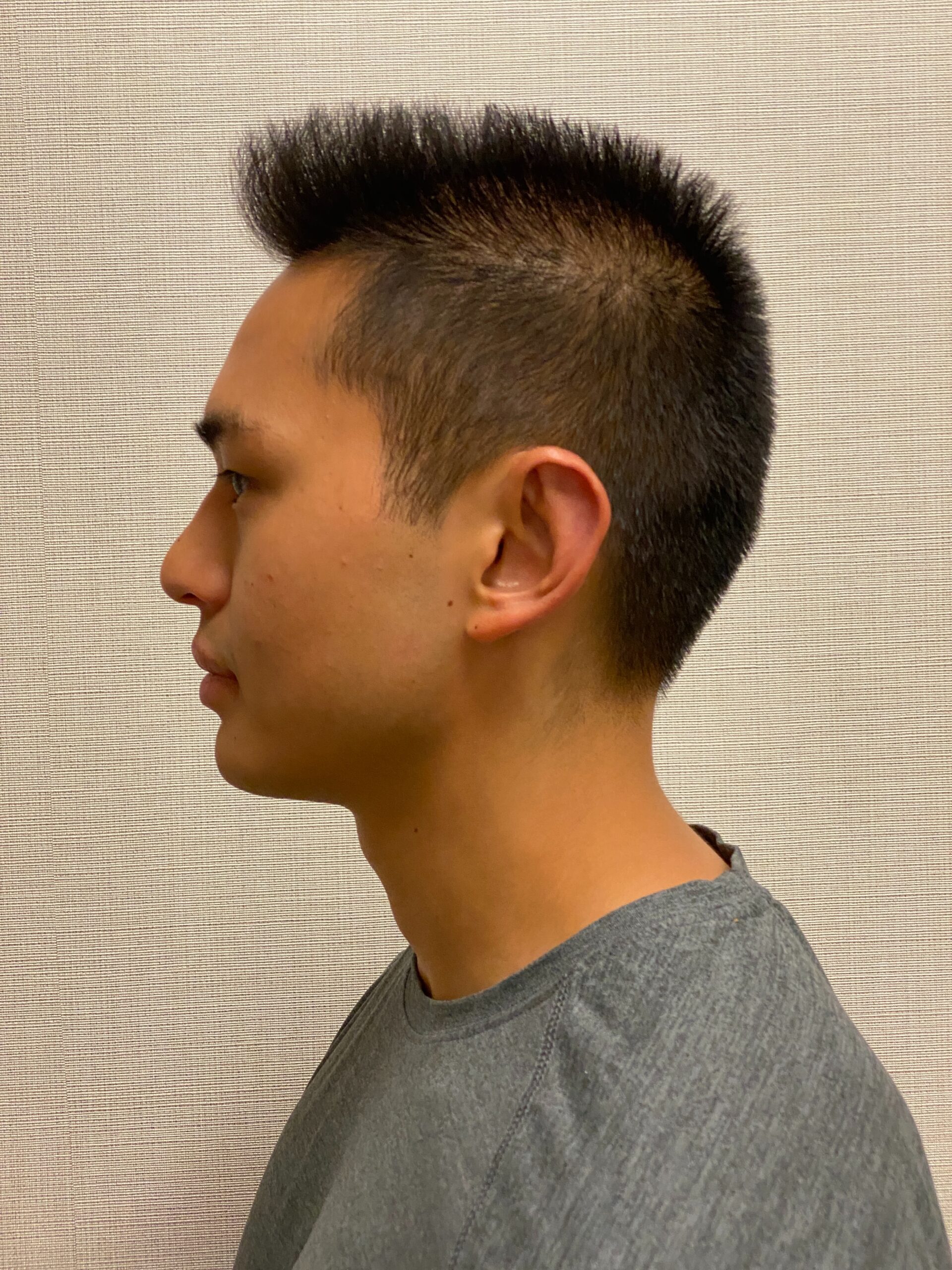 Otoplasty-Case--2681 | After Dr. Arjun Kanuri 2